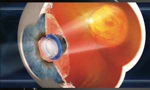 avance medico devuelve a un hombre la vision miniature telescope eye drawing 640x0