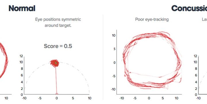 prueba conmocion cerebral