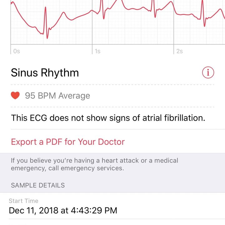 cmo usar la app ecg del apple watch 3 4 1242x2688