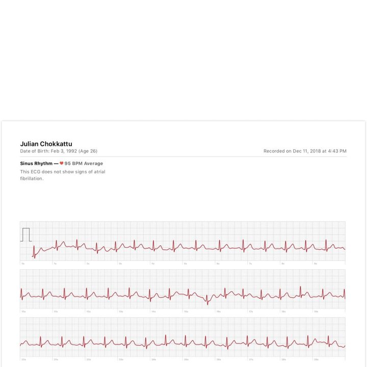cmo usar la app ecg del apple watch 4 3 1242x2688