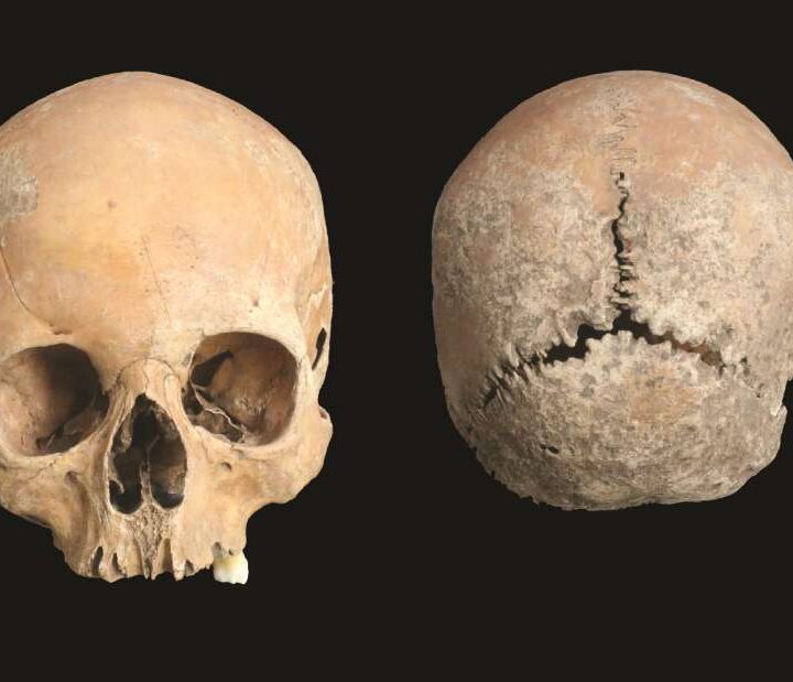 La imagen muestra las lesiones en un cráneo hallado en Inglaterra.