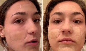 La imagen muestra a una usuaria de Tik Tok mostrando el tratamiento de parches hidrocoloides para el acné.