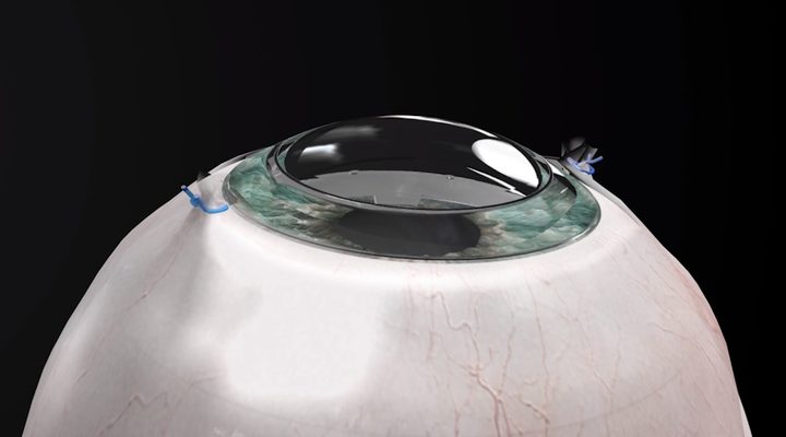 Córnea artificial de CorNeat Kpro