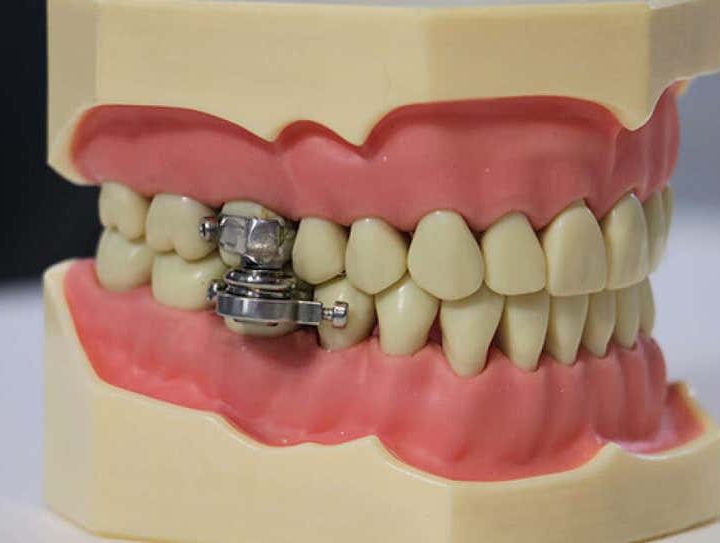 Invento para adelgazar que impide abrir la boca