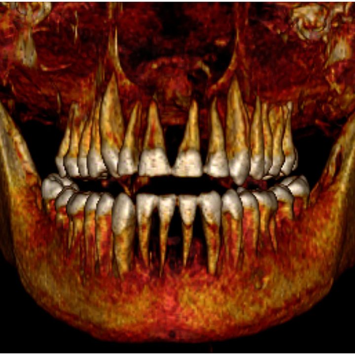 Científicos de Egipto realizan una tomografía 3D a la momia del faraón Amenhotep I