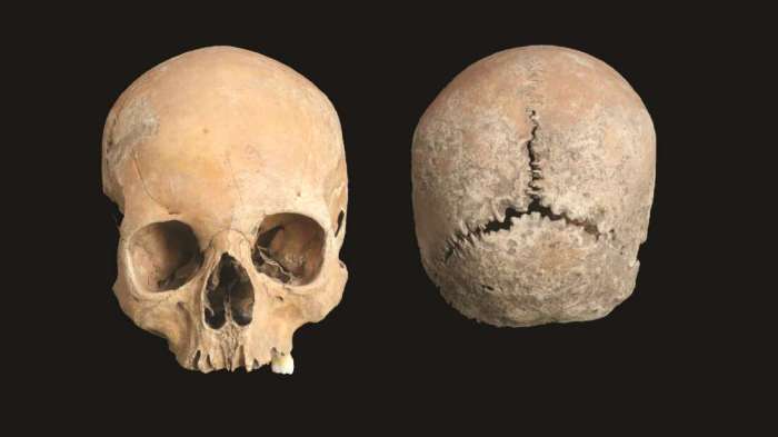 La imagen muestra las lesiones en un cráneo hallado en Inglaterra.