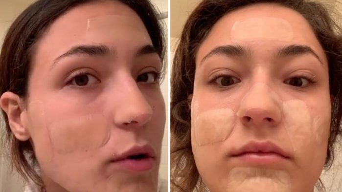 La imagen muestra a una usuaria de Tik Tok mostrando el tratamiento de parches hidrocoloides para el acné.