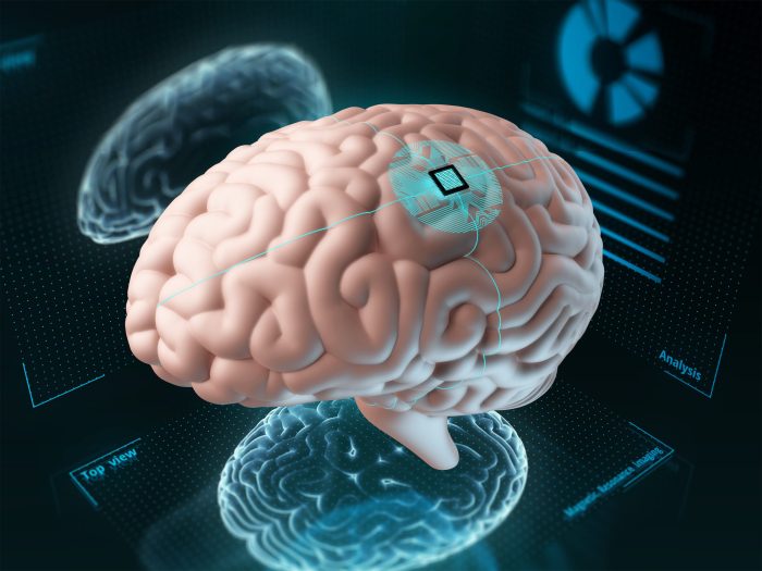implante corporal para alzheimer te mata si olvidas desactivarlo sarco human brain with an implanted chip
