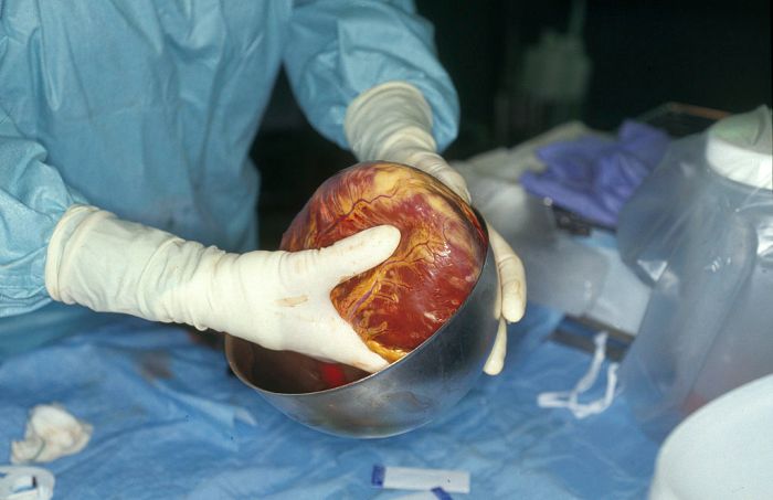 Médicos de la Facultad de Medicina de la Universidad de Maryland usaron una solución con cocaína en el histórico trasplante de un corazón de cerdo a un humano.